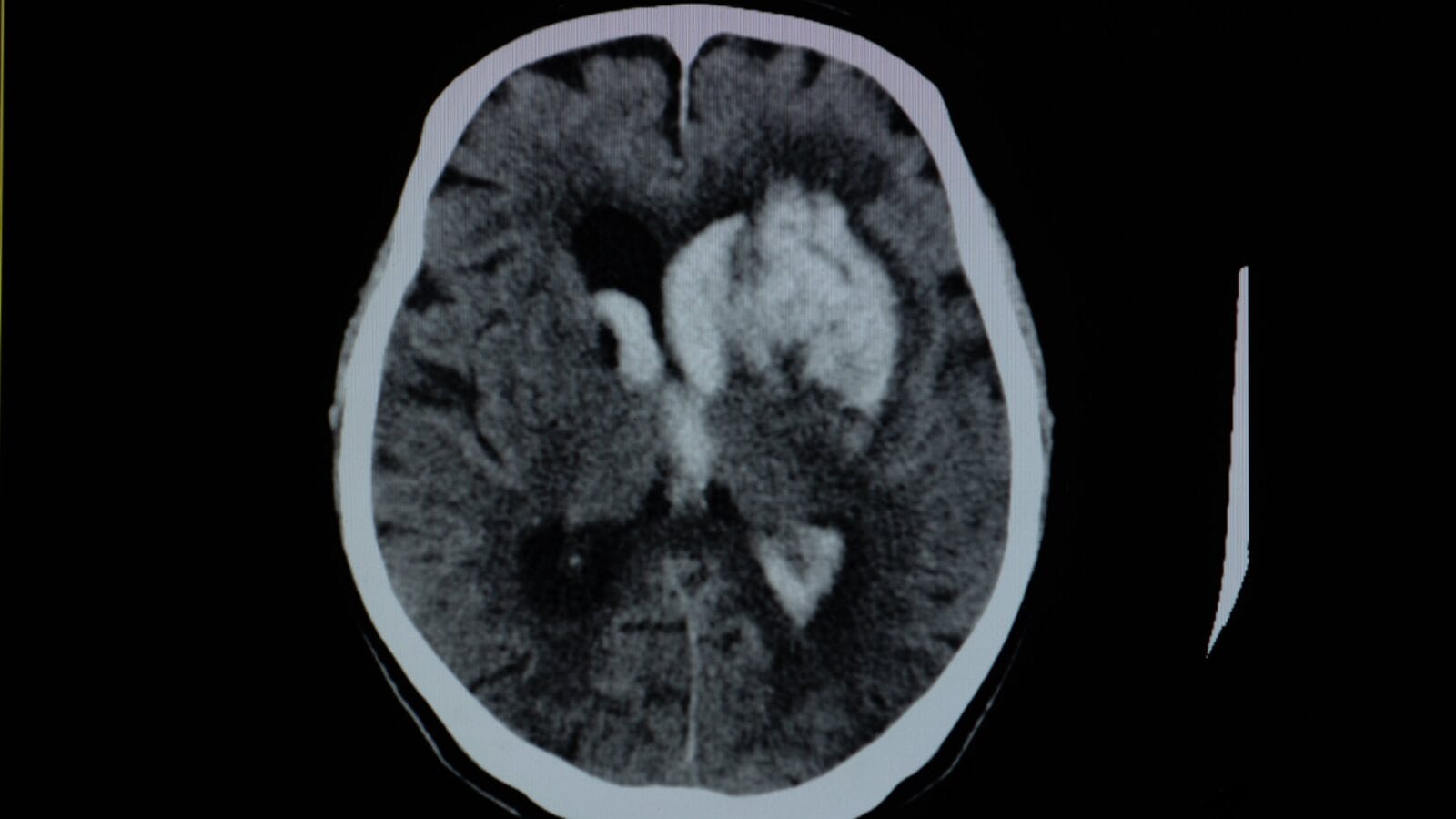 Stroke patient has Severe headache and Xray computer scan show basal ganglia hemorrhange with intracerebral hemorrhage.