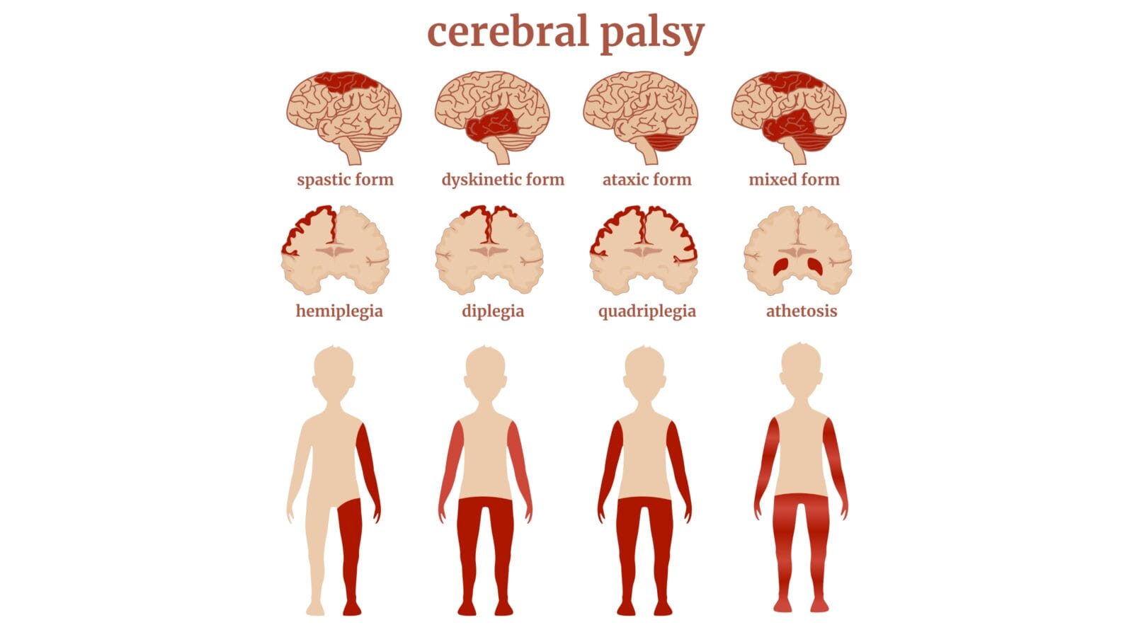 A diagram indicating the types of cerebral palsy using the example of drawings of the brain and a human figure.