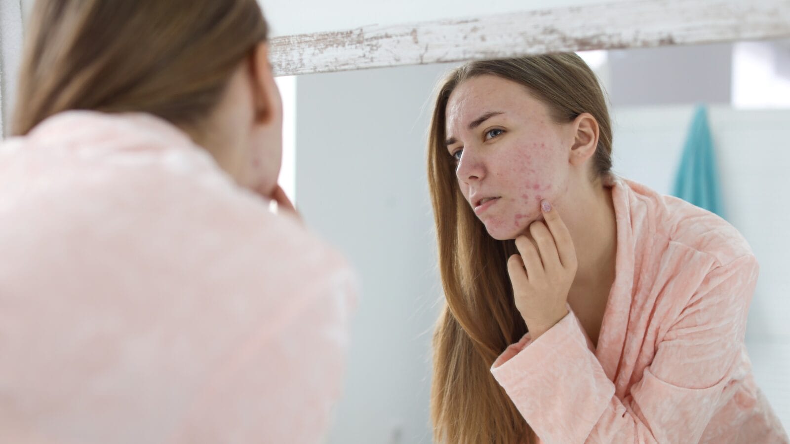 Young woman with acne problem near mirror in bathroom